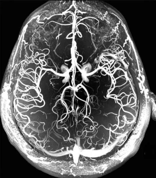 Снимок МРТ артерий головного мозга