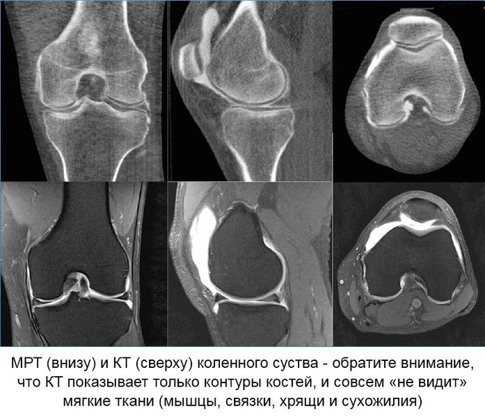 Снимки МРТ колена
