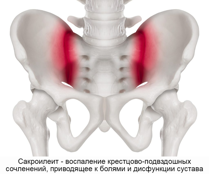 Артроз крестцово-подвздошного сочленения: причина, симптомы и лечение в Москве