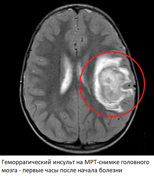 Ишемическая зона на МРТ сканах