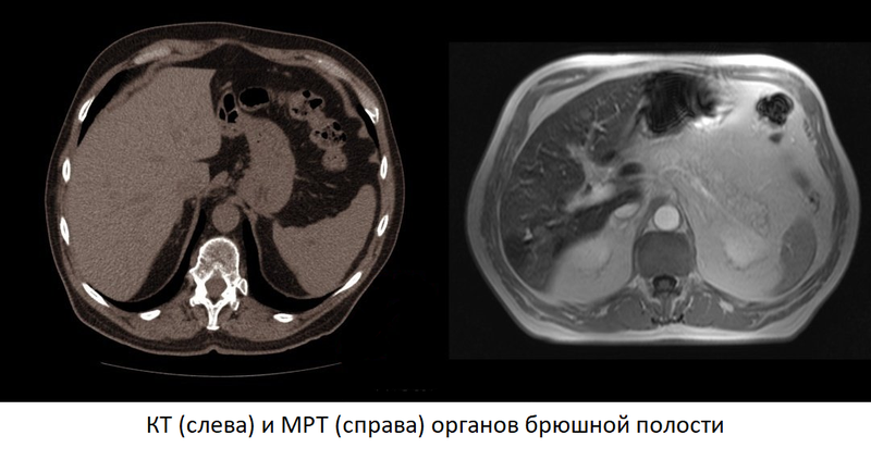 КТ и МРТ брюшной полости
