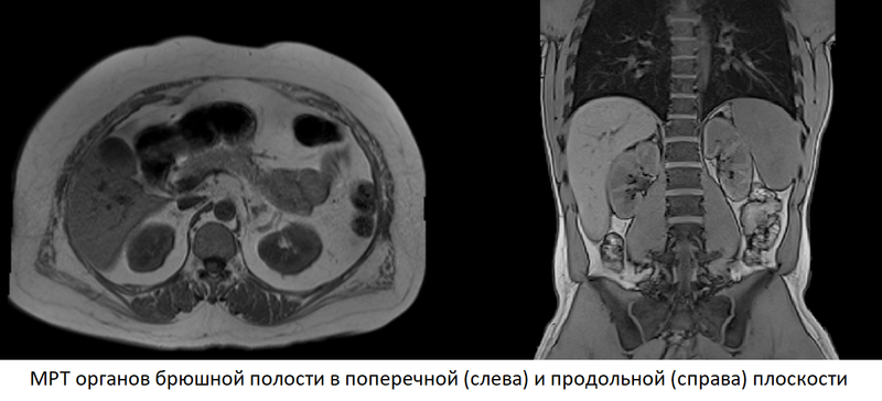 Компьютерная томография брюшной полости фото